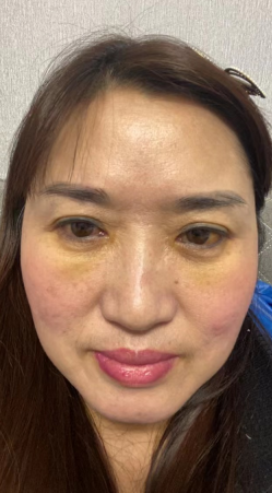 去眼袋手术