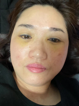 去眼袋手术