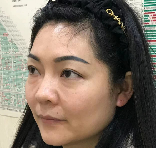 去眼袋手术