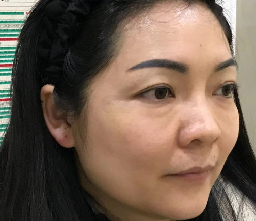 去眼袋手术