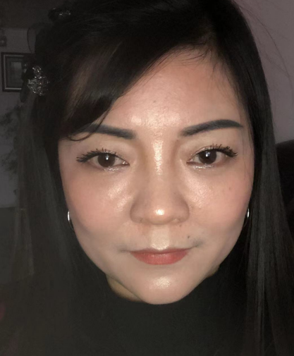 去眼袋手术