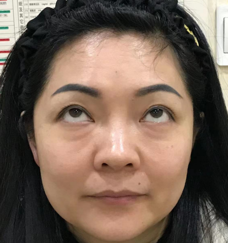去眼袋手术