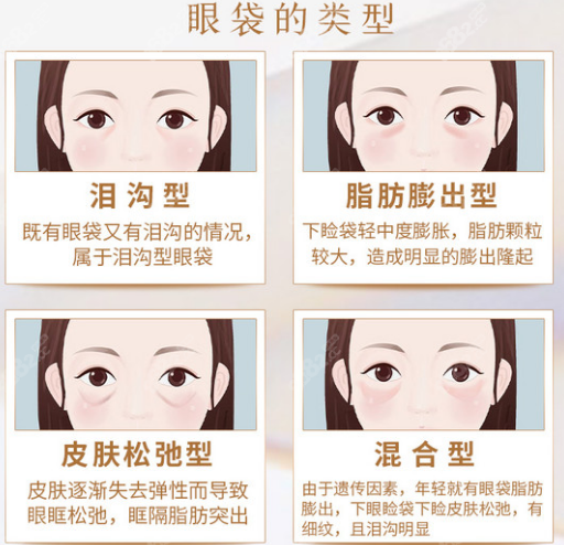去眼袋手术