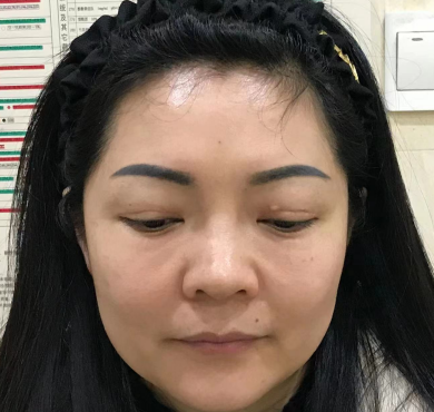 去眼袋手术