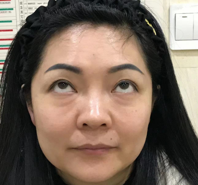 去眼袋手术