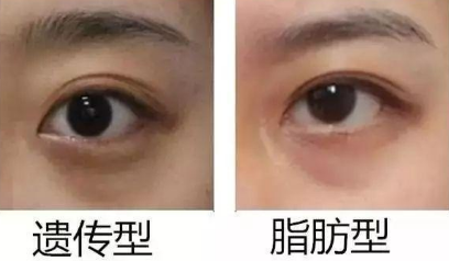 去眼袋手术