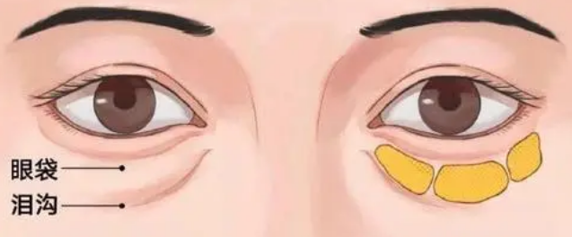 在超雅做眼袋手术过程复杂吗?效果呢?416 在超雅做眼袋手术过程复杂吗?效果呢?416