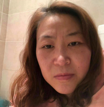 去眼袋手术