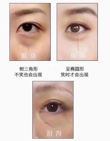 去眼袋手术