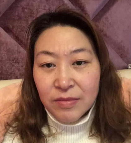 去眼袋手术