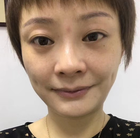 去眼袋手术