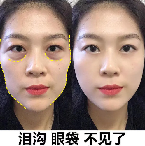 去眼袋手术