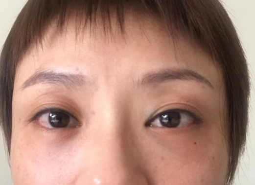 去眼袋手术