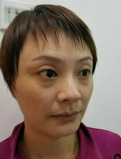 去眼袋手术