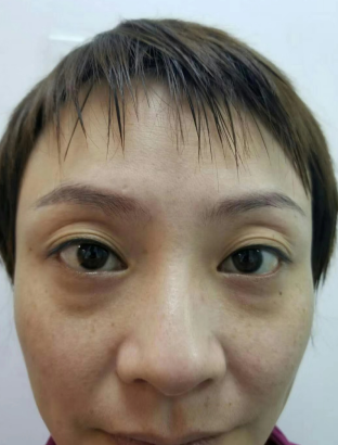 去眼袋手术