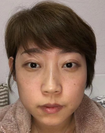 去眼袋手术