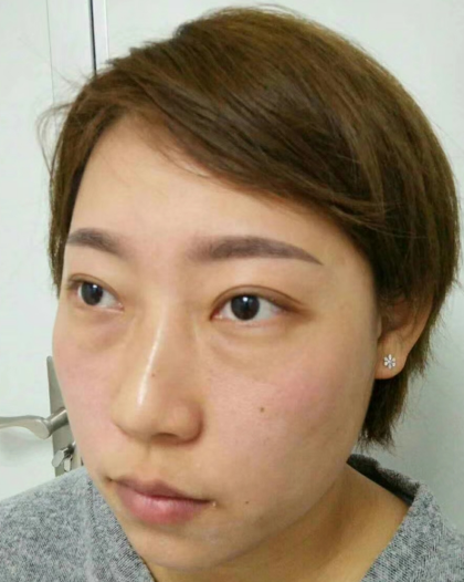 去眼袋手术
