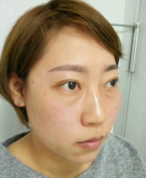 去眼袋手术