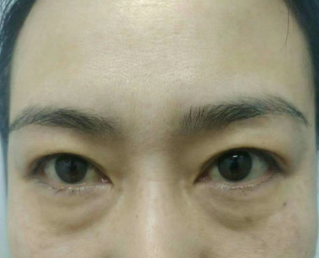 去眼袋手术