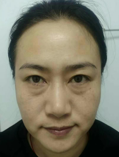 去眼袋手术