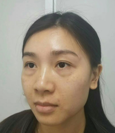 去眼袋手术