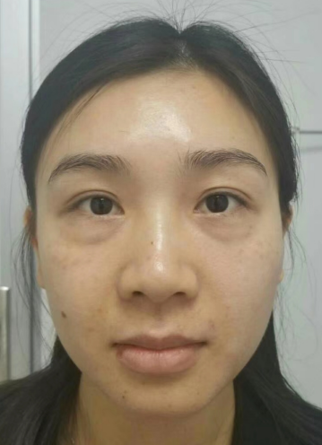 去眼袋手术