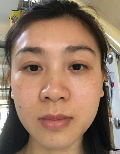 去眼袋手术