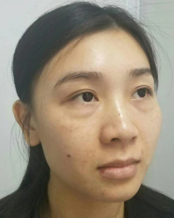 去眼袋手术