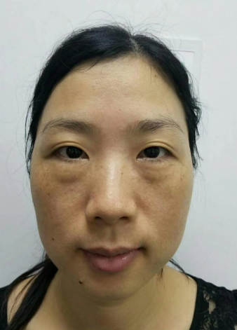 去眼袋手术