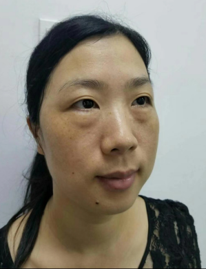 去眼袋手术