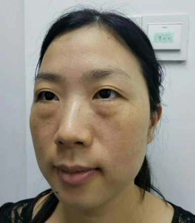 去眼袋手术