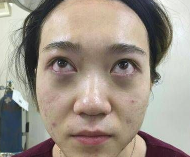 去眼袋手术
