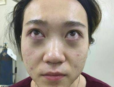 去眼袋手术