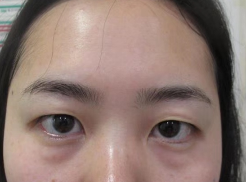 年轻人是会长眼袋的?那你选择怎么解决?567 年轻人是会长眼袋的?那你选择怎么解决?567