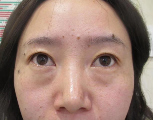 打卡说下不开刀按摩去眼袋后的恢复情况800 打卡说下不开刀按摩去眼袋后的恢复情况800