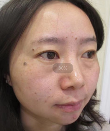 打卡说下不开刀按摩去眼袋后的恢复情况800 打卡说下不开刀按摩去眼袋后的恢复情况800