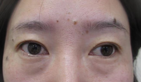 打卡说下不开刀按摩去眼袋后的恢复情况800 打卡说下不开刀按摩去眼袋后的恢复情况800