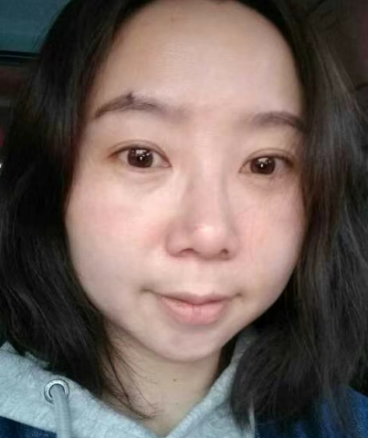 去眼袋手术