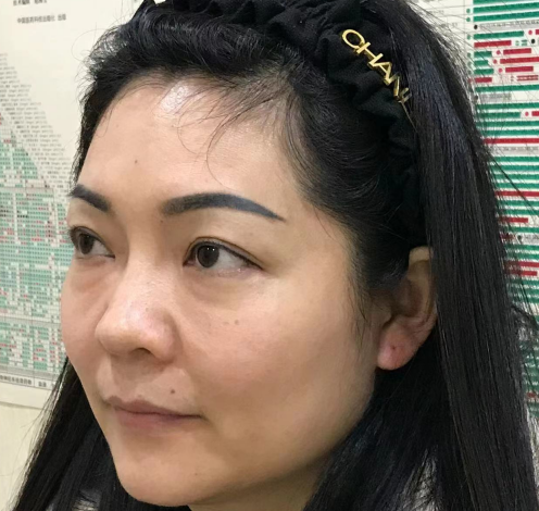 去眼袋手术