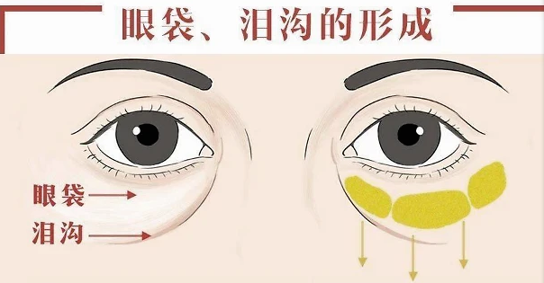 去眼袋手术