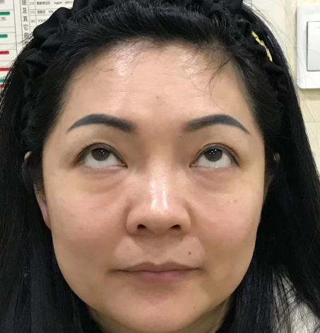 去眼袋手术