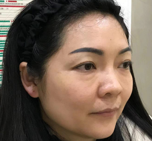 去眼袋手术