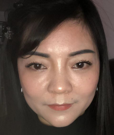 去眼袋手术