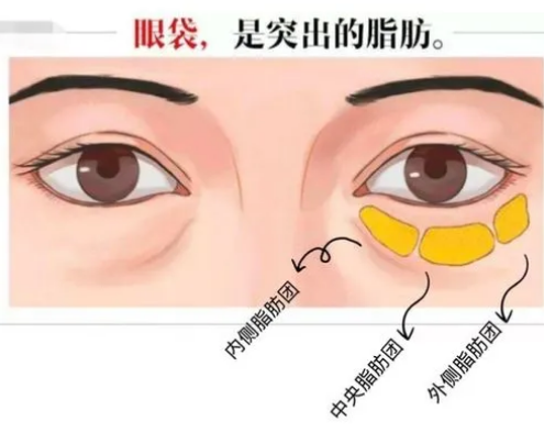 去眼袋手术