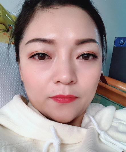 去眼袋手术