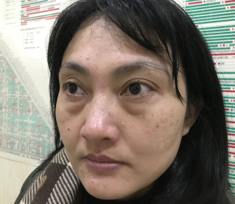 去眼袋手术