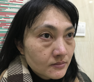 去眼袋手术