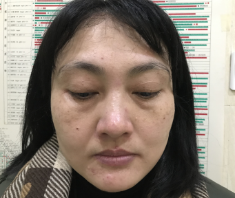 去眼袋手术