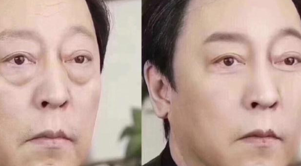 去眼袋手术