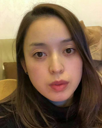 去眼袋手术